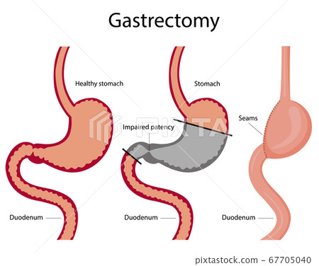 Vector illustration of gastrectomy. - Stock Illustration [67705040] - PIXTA