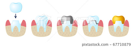 Icons on the dental Theme. Service installation of a ceramic crown. Icons on the dental Theme. Service installation of a ceramic crown. 67710879