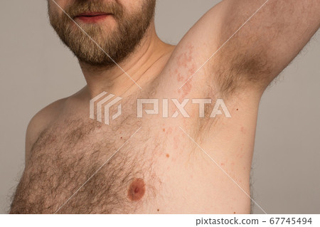 Allergy reaction is red spots on the body of a 67745494