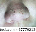 Purulent acne in the nose. Selective focus. 67779212