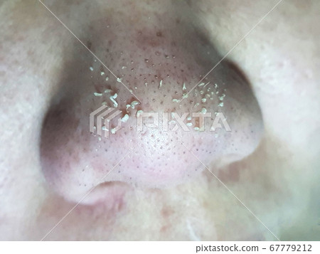 Purulent acne in the nose. Selective focus. Purulent acne in the nose. Selective focus. 67779212
