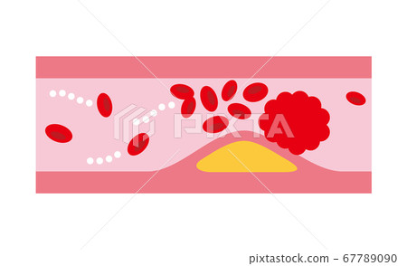 狹窄的血管 67789090