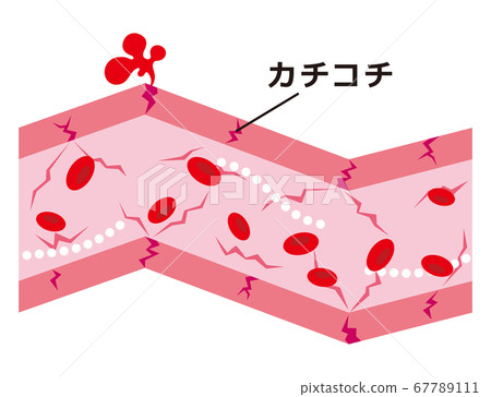 Hardened blood vessels - Stock Illustration [67789111] - PIXTA