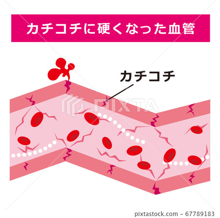 血管硬化 67789183