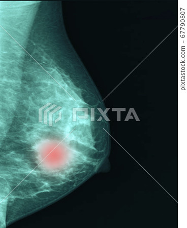 breast cancer images 67790807