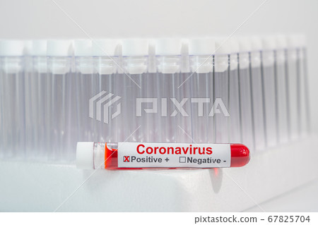 Coronavirus infection blood test sample in vacuum venipuncture tube 67825704