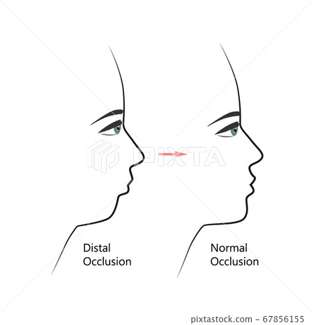 Distal bite profile before and after orthodontic treatment. Human with malocclusion, lower jaw pushing back, bite correction by braces. Vector illustration Distal bite profile before and after orthodontic treatment. Human with malocclusion, lower jaw pushing back, bite correction by braces. Vector illustration 67856155