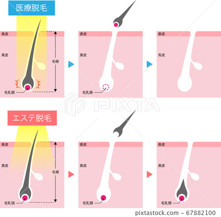 Medical Hair Removal Esthetic Hair Removal Mechanism Cross Section Medical Hair Removal Esthetic Hair Removal Mechanism Cross Section 67882100