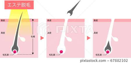 美容脫毛機構截面 美容脫毛機構截面 67882102