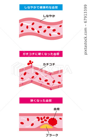 健康血管動脈硬化血管 67913399