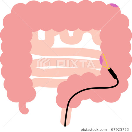 Illustration of large intestine polyp Internal organ digestive examination 67925733