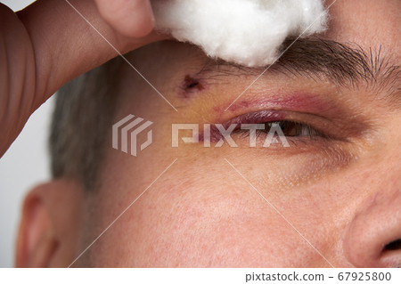 close view of a bruise near the eye, the face of a close view of a bruise near the eye, the face of a 67925800