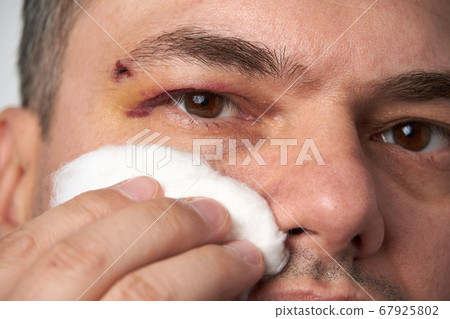 close view of a bruise near the eye, the face of a close view of a bruise near the eye, the face of a 67925802