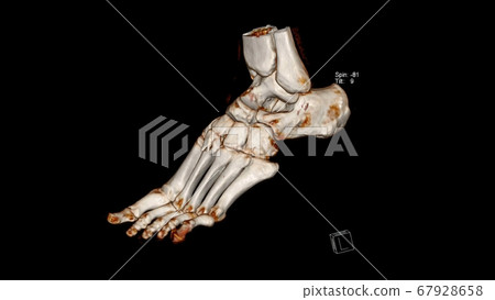 Computed Tomography Volume Rendering examination of the Foot ( CT VR Foot) . 3D rendering Computed Tomography Volume Rendering examination of the Foot ( CT VR Foot) . 3D rendering 67928658