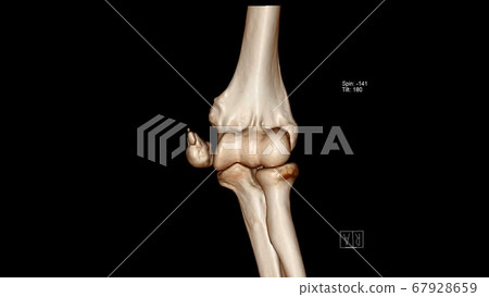 Computed Tomography Volume Rendering examination of the Elbow joint ( CT VR Elbow) showing fracture of the medial epicondyle Computed Tomography Volume Rendering examination of the Elbow joint ( CT VR Elbow) showing fracture of the medial epicondyle 67928659