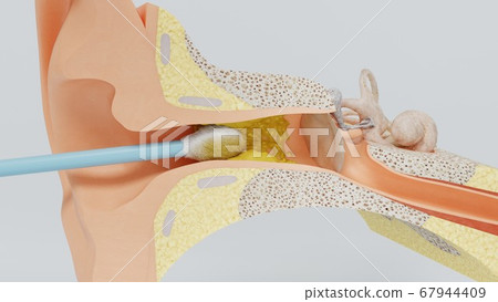 3d render ear cleansing earwax ear stick. 3d illustration 67944409