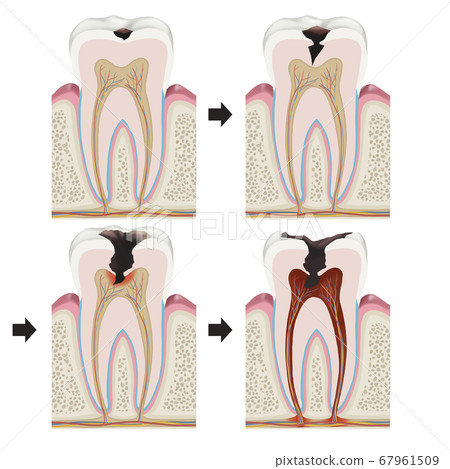 蛀牙的階段 蛀牙的階段 67961509