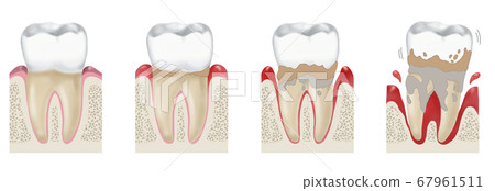 牙齦炎和牙周炎的插圖 67961511