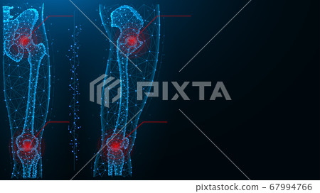Pain in the hip and knee joint blue polygonal Pain in the hip and knee joint blue polygonal 67994766