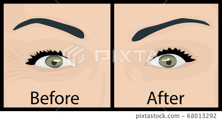 Wrinkles and fine lines under eyes to remove. Before and After. Eyes lifting 68013292