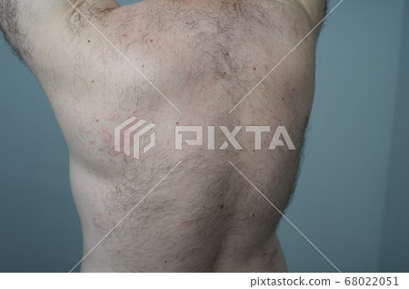 Allergy reaction is red spots on the body of a 68022051