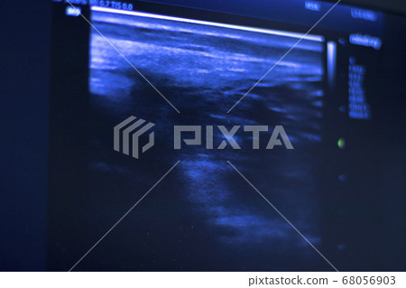 EPI dry needling ultrasound scan 68056903