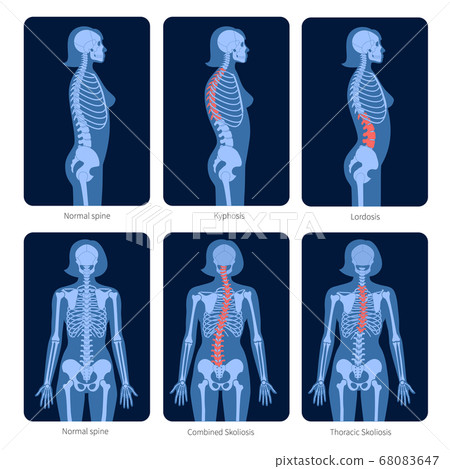 Spine X ray Spine X ray 68083647