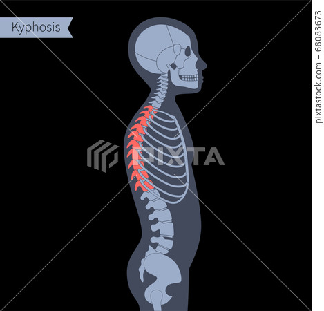 Spine X ray Spine X ray 68083673