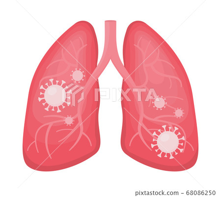 Human lungs infected viral pneumonia and covid 19 Human lungs infected viral pneumonia and covid 19 68086250