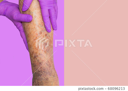 Close-up of skin with varicose veins 68096213