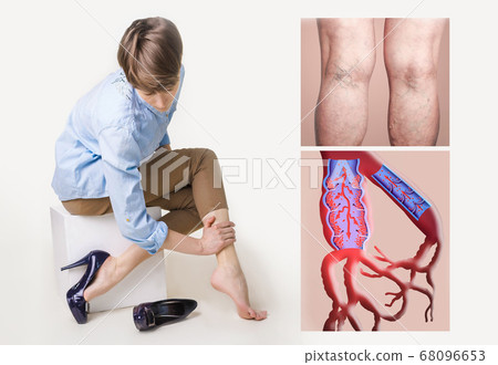 Varicose veins on a female senior legs. The 68096653