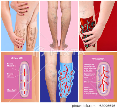 Varicose veins on a female senior legs. The 68096656