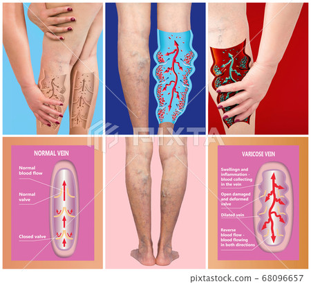Varicose veins on a female senior legs. The 68096657