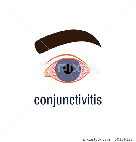 Conjunctivitis icon isolated on white background. Watery red eye logo. Viral infection season allergy eye disease virus inflammation symptom. Color flat style Ophthalmology medical vector illustration 68136132