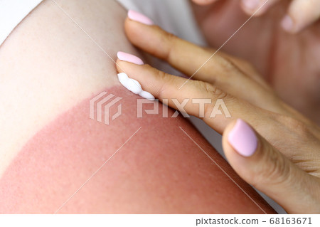 Female hand applies sunburn cream to male hand Female hand applies sunburn cream to male hand 68163671