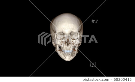 Computed Tomography of the Skull (facial bones) in 3D (CT VR facial bones). 3D rendering Computed Tomography of the Skull (facial bones) in 3D (CT VR facial bones). 3D rendering 68200415