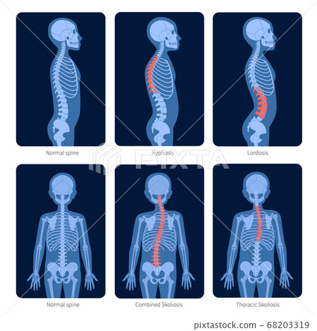Spine X ray Spine X ray 68203319