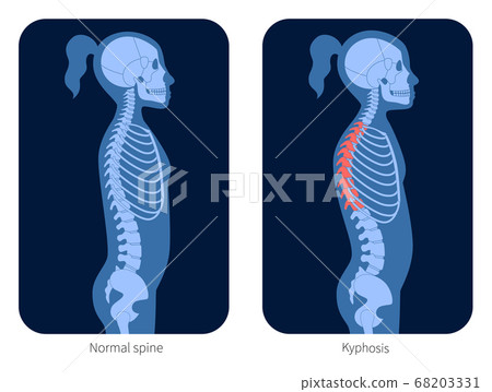 Spine X ray Spine X ray 68203331