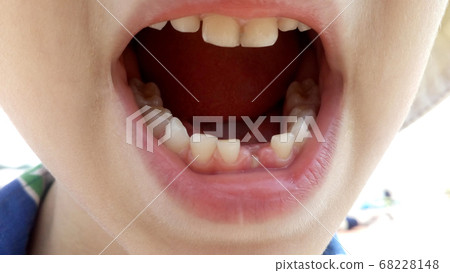The first milk tooth fell out. Teeth in the mouth The first milk tooth fell out. Teeth in the mouth 68228148