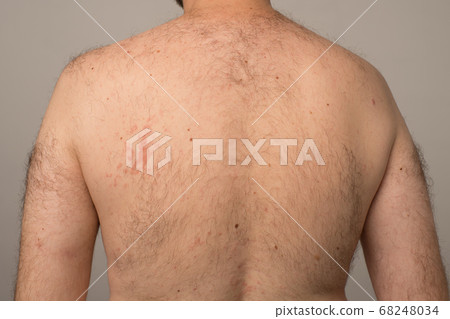 Allergy reaction is red spots on the body of a Allergy reaction is red spots on the body of a 68248034