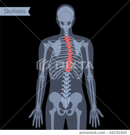 Spine X ray Spine X ray 68292800