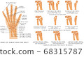 Wrist Fractures.eps 68315787