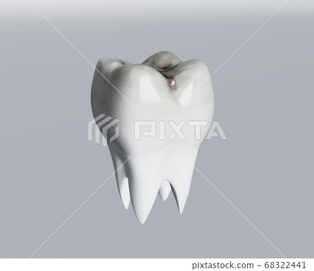 Cavities of molar tooth, tooth decay, caries. 3d 68322441