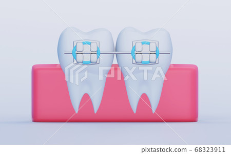Two Teeth with Metal Braces, molars in the gums Two Teeth with Metal Braces, molars in the gums 68323911