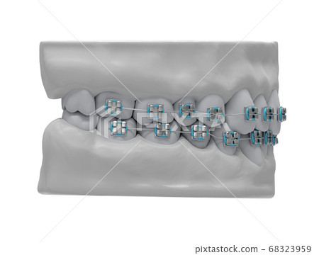 Human jaws with healthy teeth and classic metal Human jaws with healthy teeth and classic metal 68323959