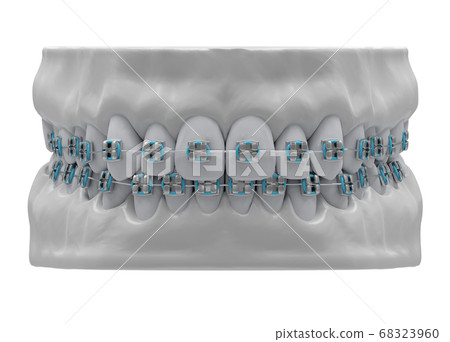 Human jaws with healthy teeth and classic metal 68323960