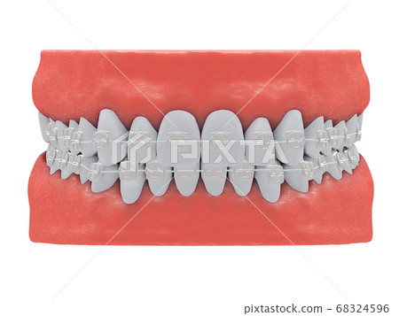 invisible braces 68324596