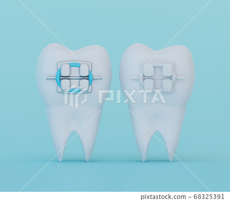 Tooth with Metal Braces and Tooth with Ceramic Braces on blue background. Comparison of braces and brace selection concept, 3d render Tooth with Metal Braces and Tooth with Ceramic Braces on blue background. Comparison of braces and brace selection concept, 3d render 68325391