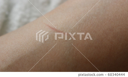 Scratches on the skin 68340444