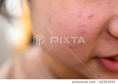 痤瘡兒童小學生 68363044